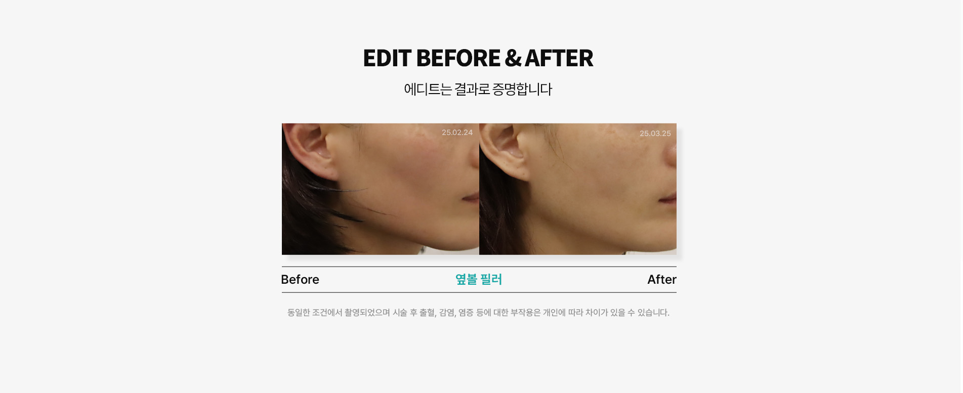 볼/턱라인필러 전후사진