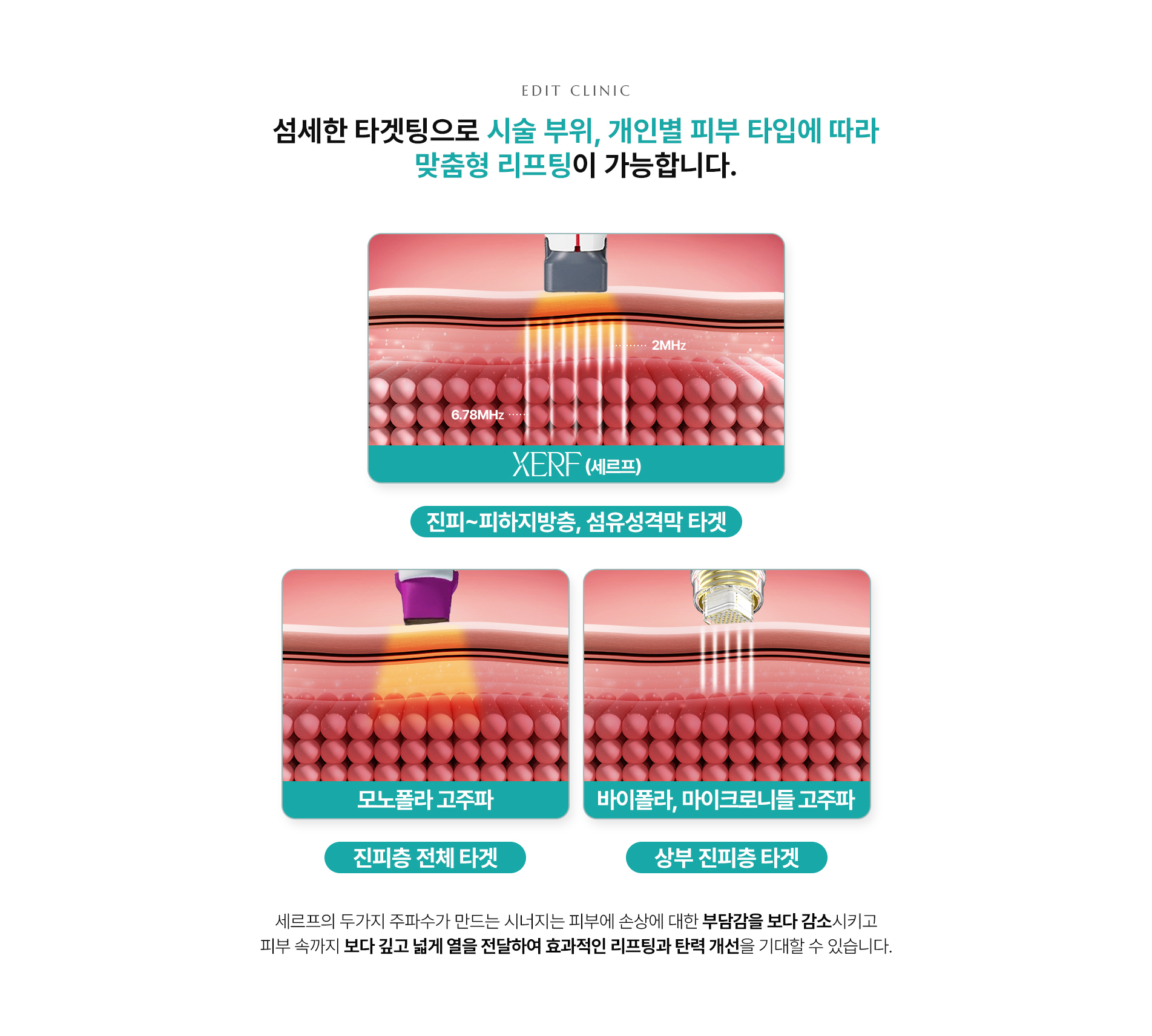 세르프 리프팅 맞춤형 리프팅