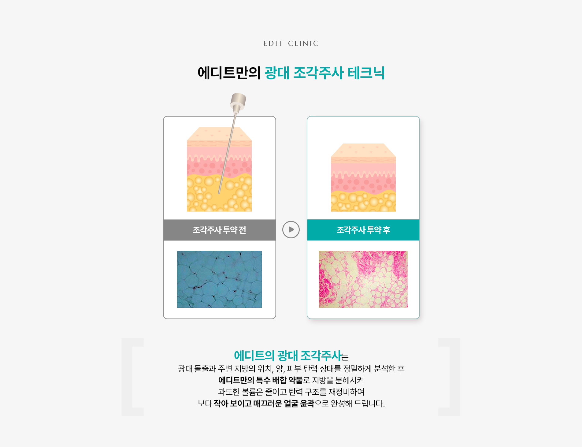 광대조각주사 테크닉