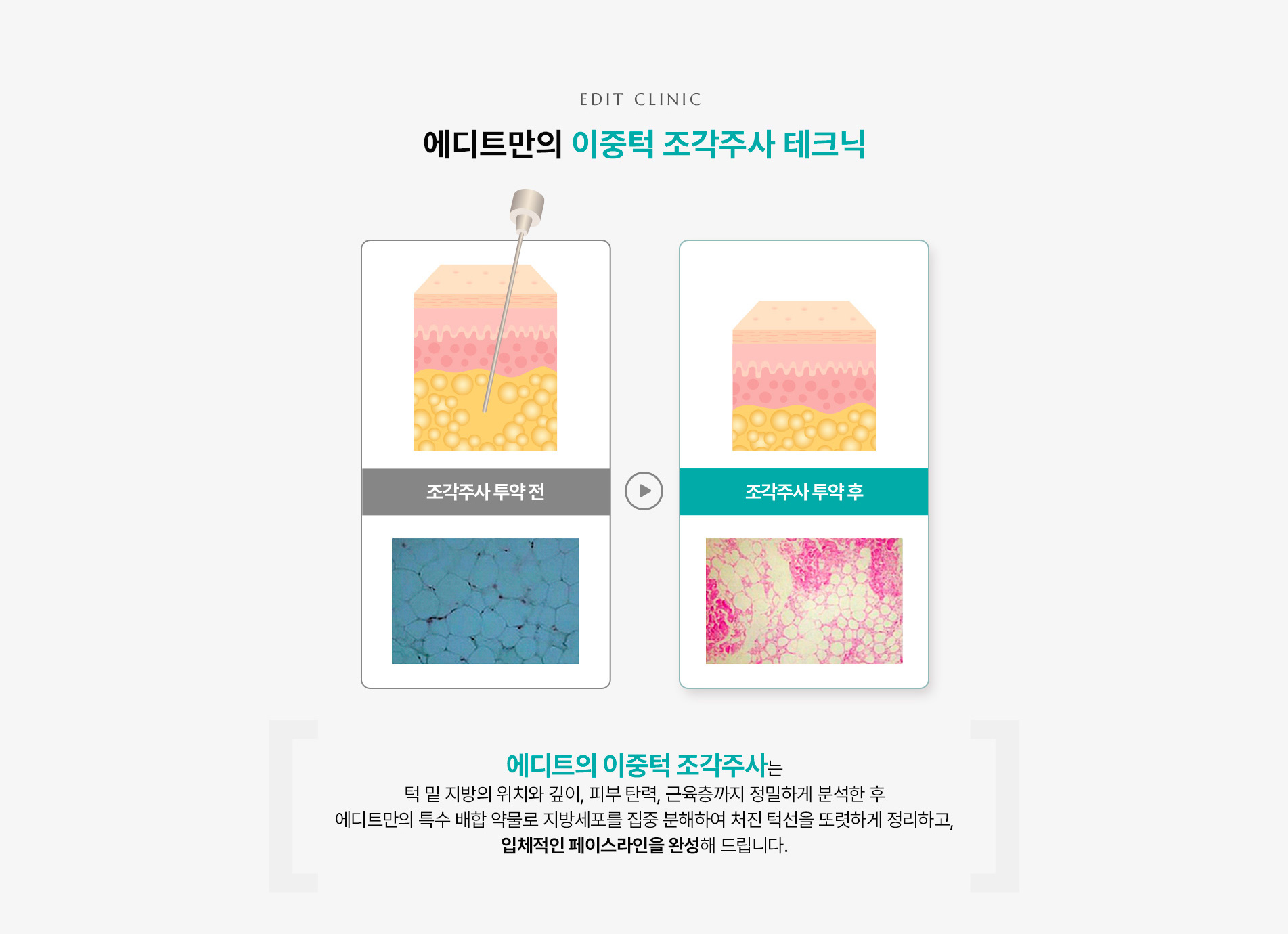 광대조각주사3