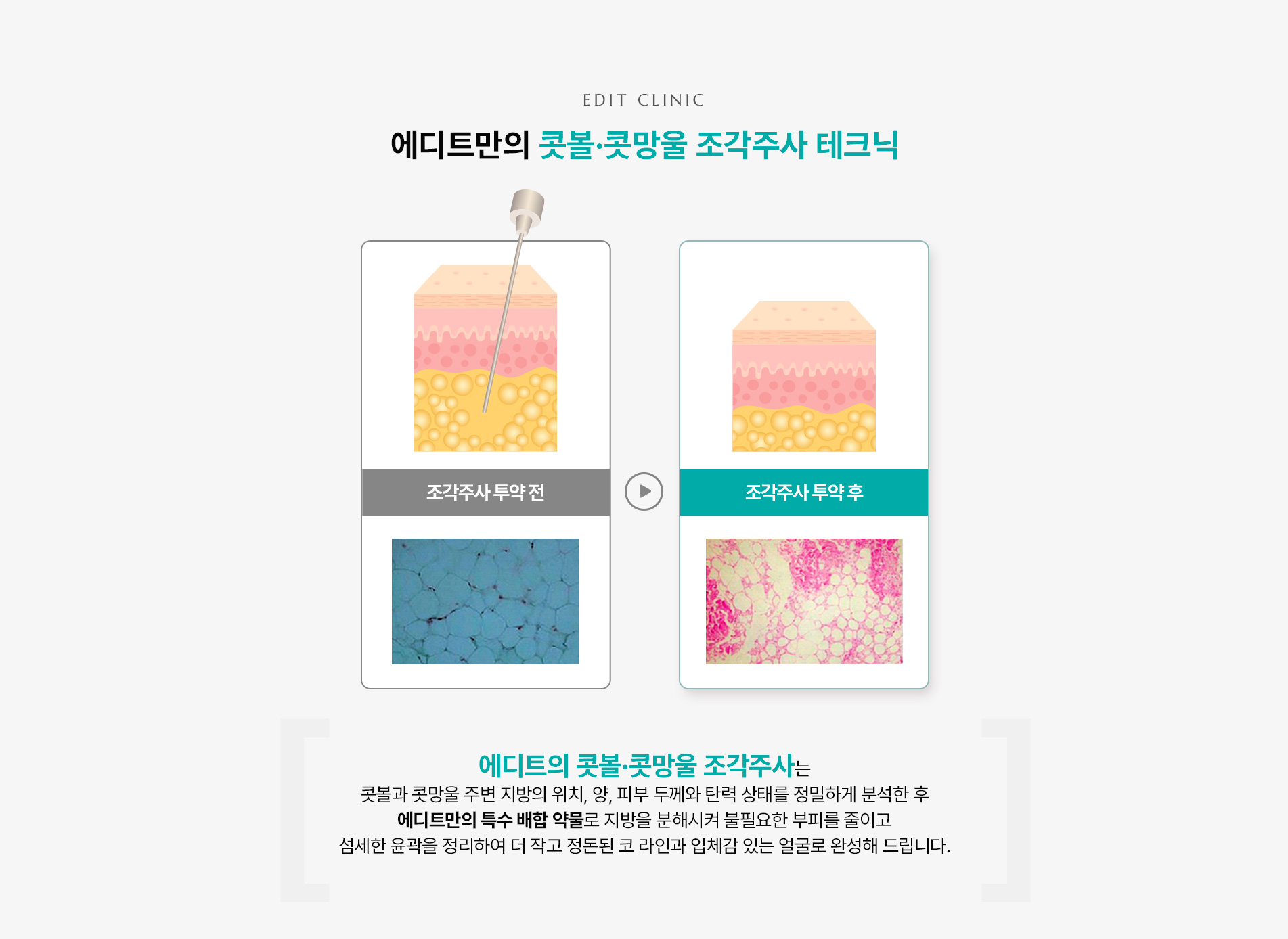 콧볼,콧망울03