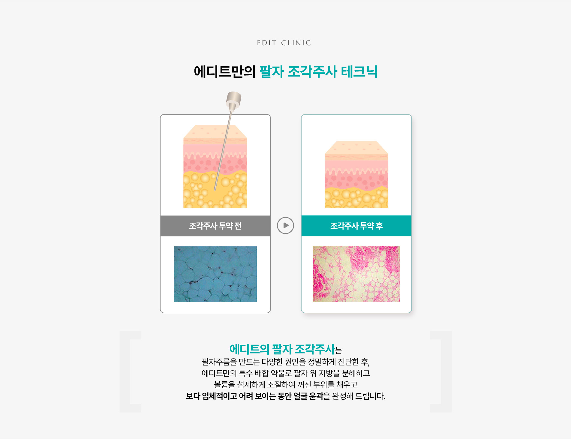 팔자조각주사03
