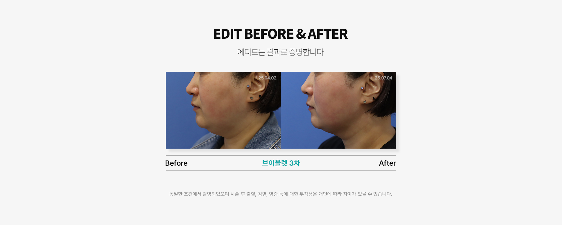에디트의 브이올렛주사 특징