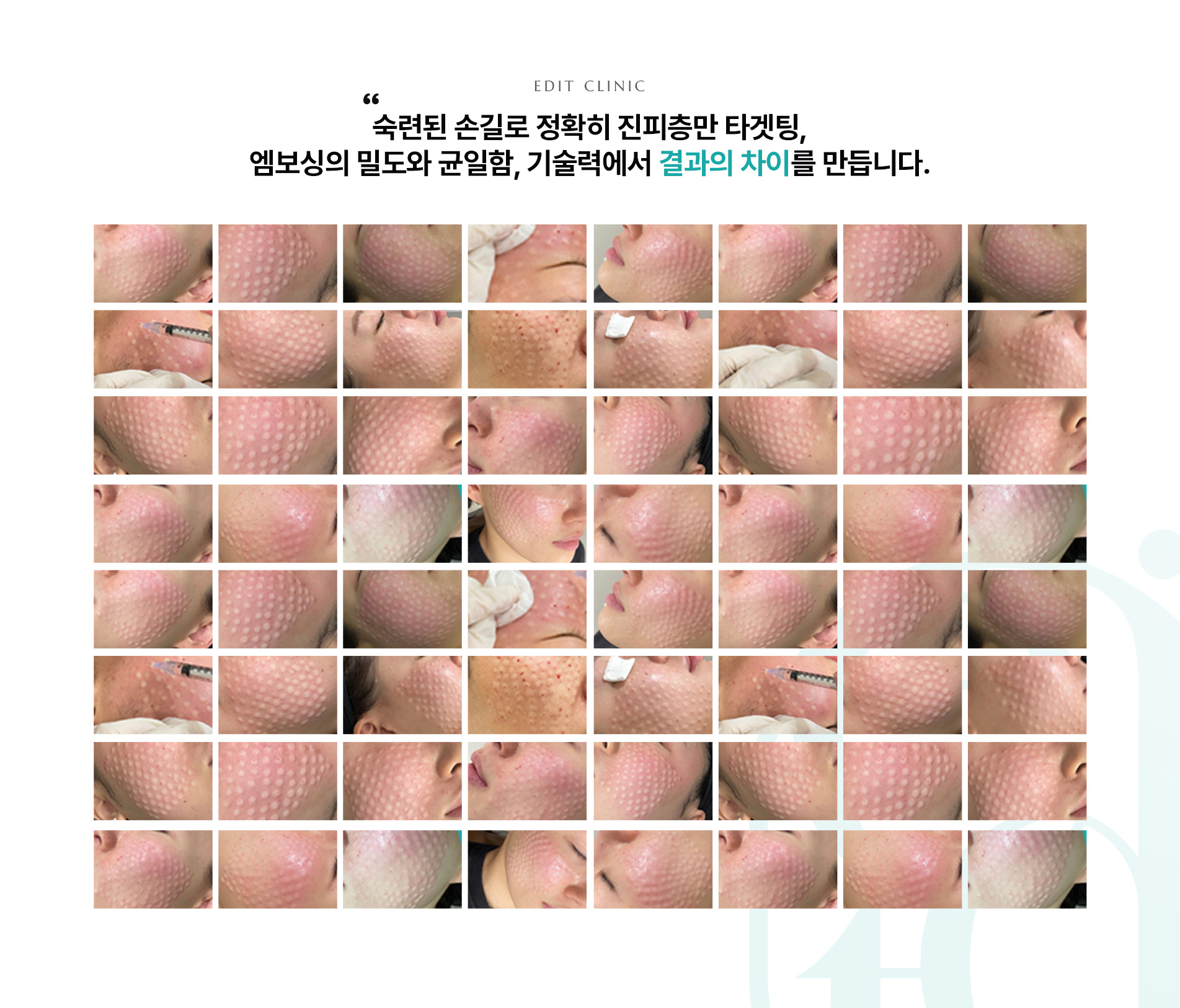 콜라겐리프팅