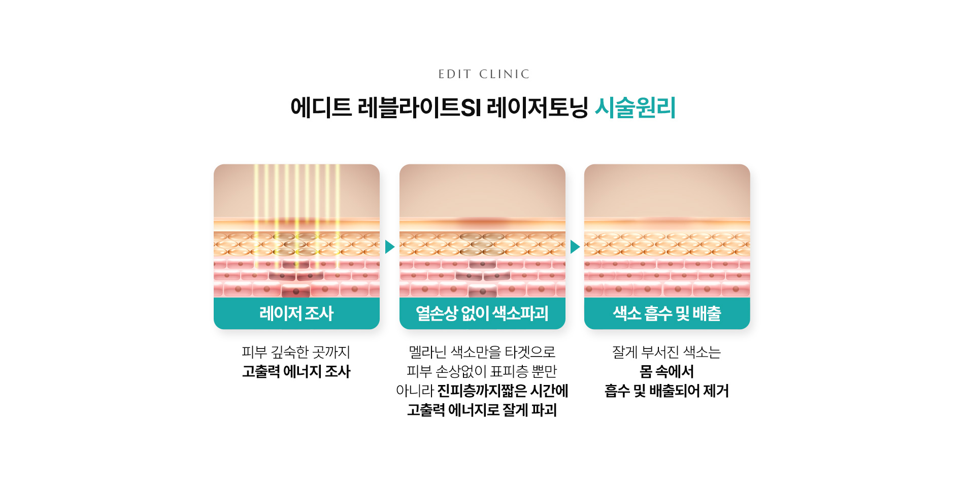 레블라이트SI 레이저토닝02