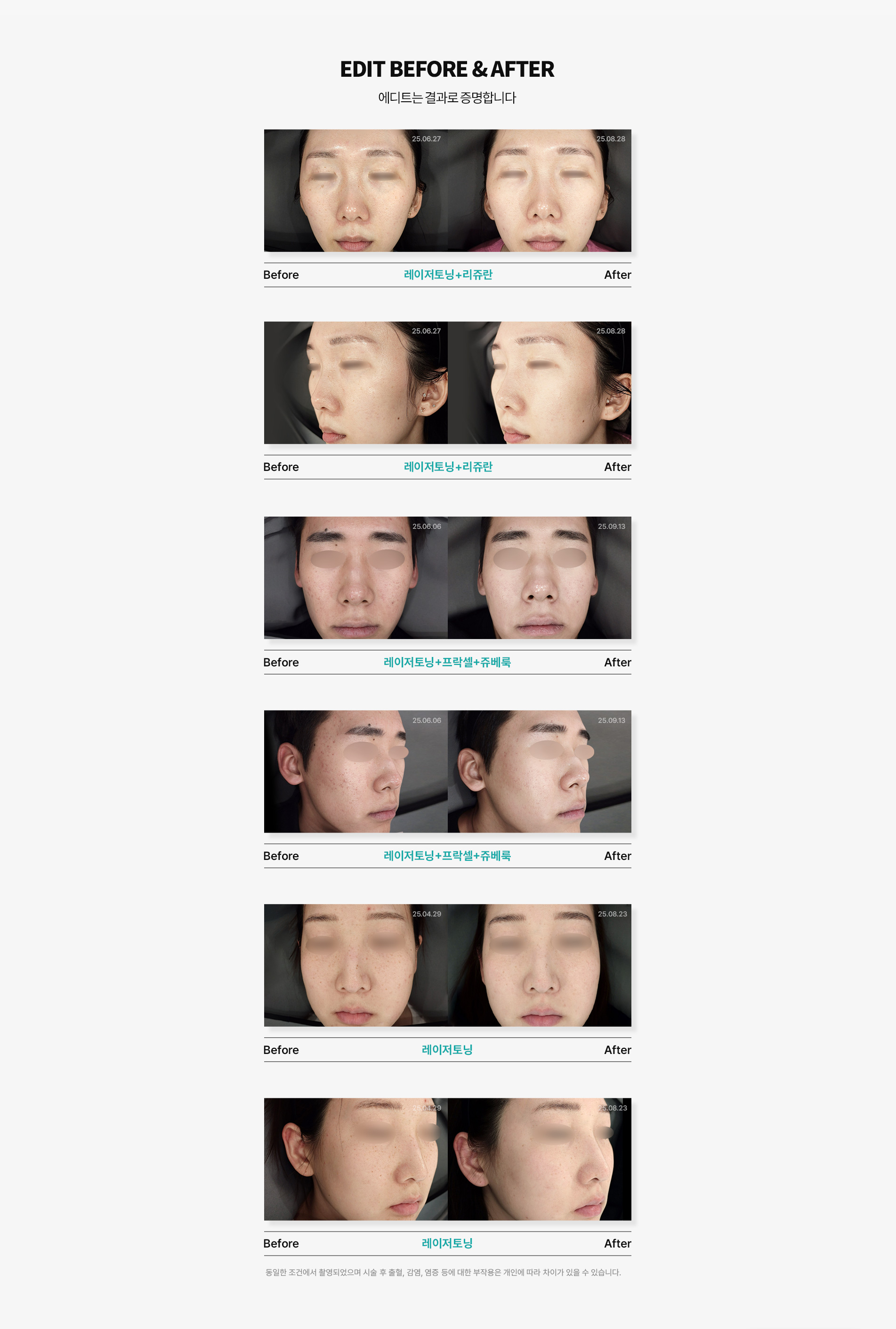 레블라이트SI 레이저토닝08